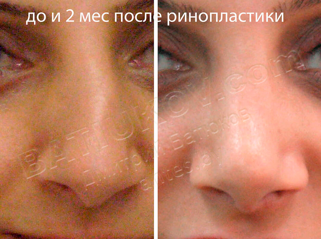 Сломанный нос до и после ринопластики
